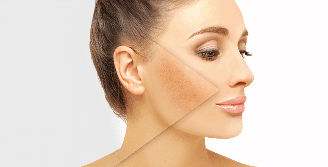 Pigmentation Treatment